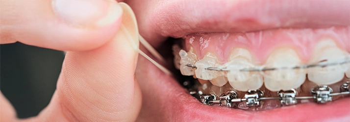 Compliance and Cooperation With Your Orthodontist In Avon CT